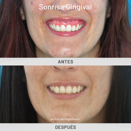 Sonrisa gingival